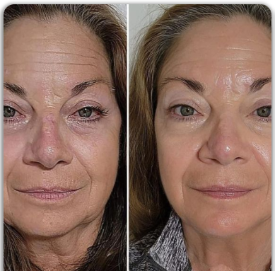 VenoLifta Firming Anti-Ageing Roll-On Serum | Visibly Reduces Wrinkles in Just 17 Minutes